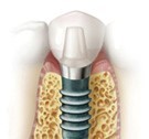 インプラント