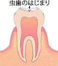 虫歯のはじまり