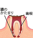 歯冠部(歯の頭の部分)が溶けて、歯根だけが残った状態