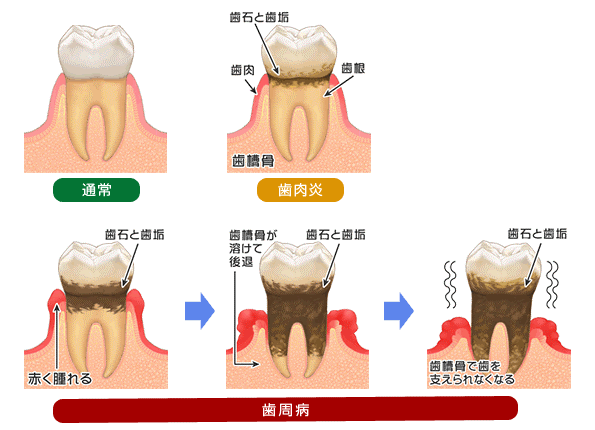 歯周病