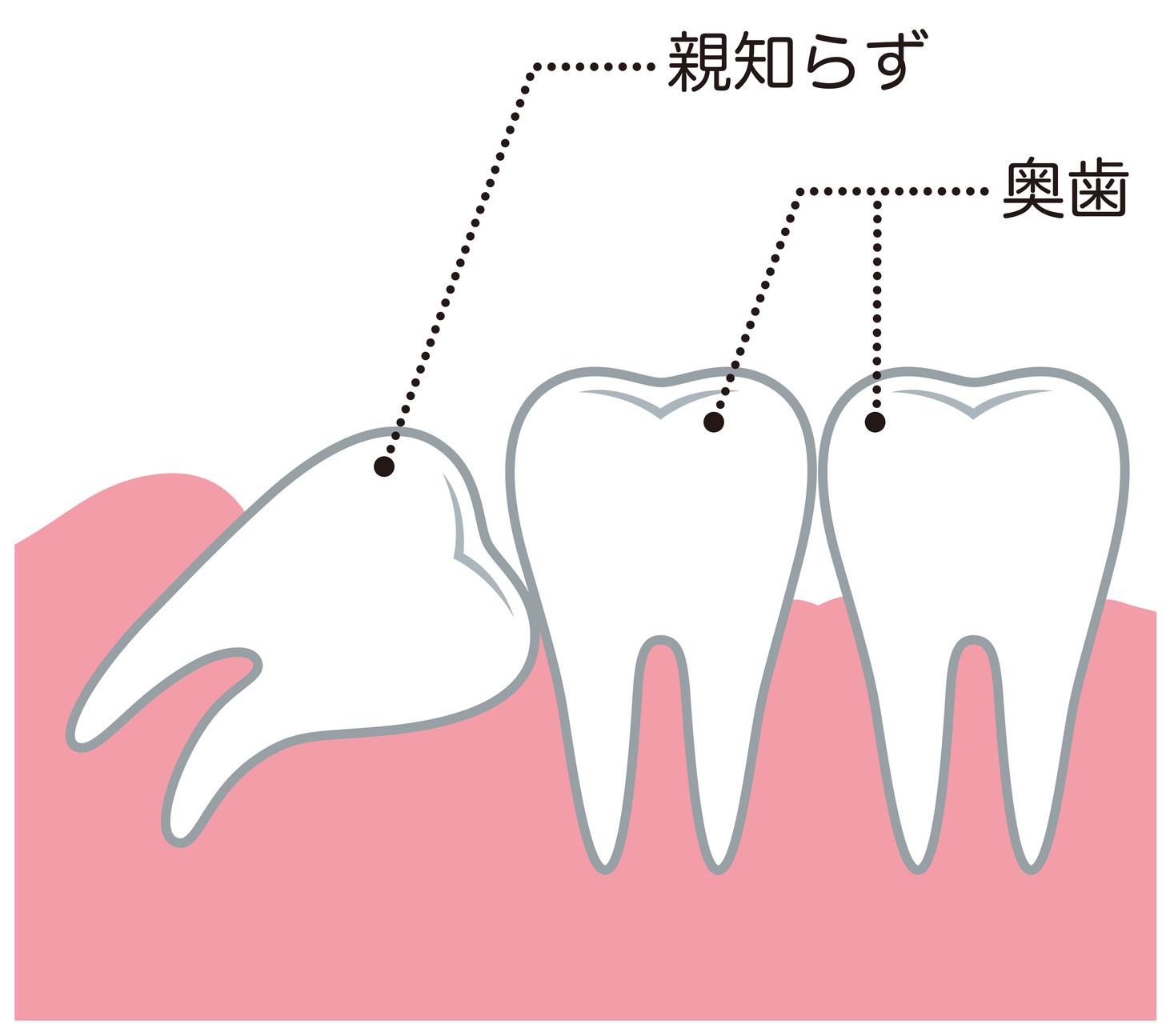 親知らずのイラスト